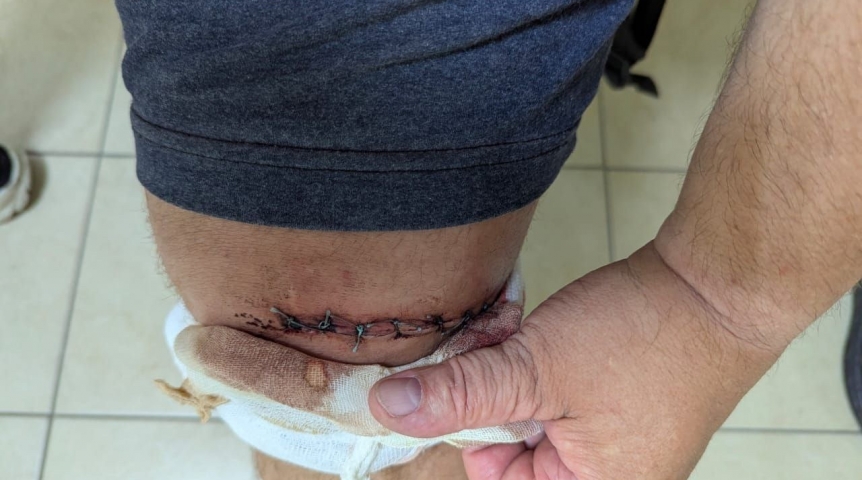 Омич распорол себе ногу о мост у Телецентра