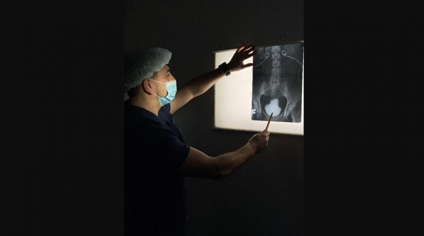 В организме омички обнаружили камень размером с большой кулак