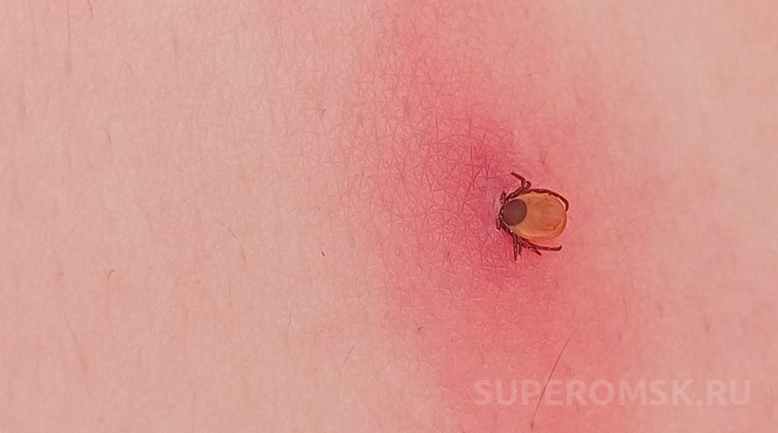 В Омске подросток попал в реанимацию после укусов двух клещей