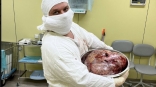 Онкологи омского диспансера прооперировали пациентку с огромной опухолью